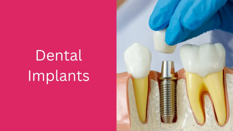 Are Dental Implants Covered by Insurance